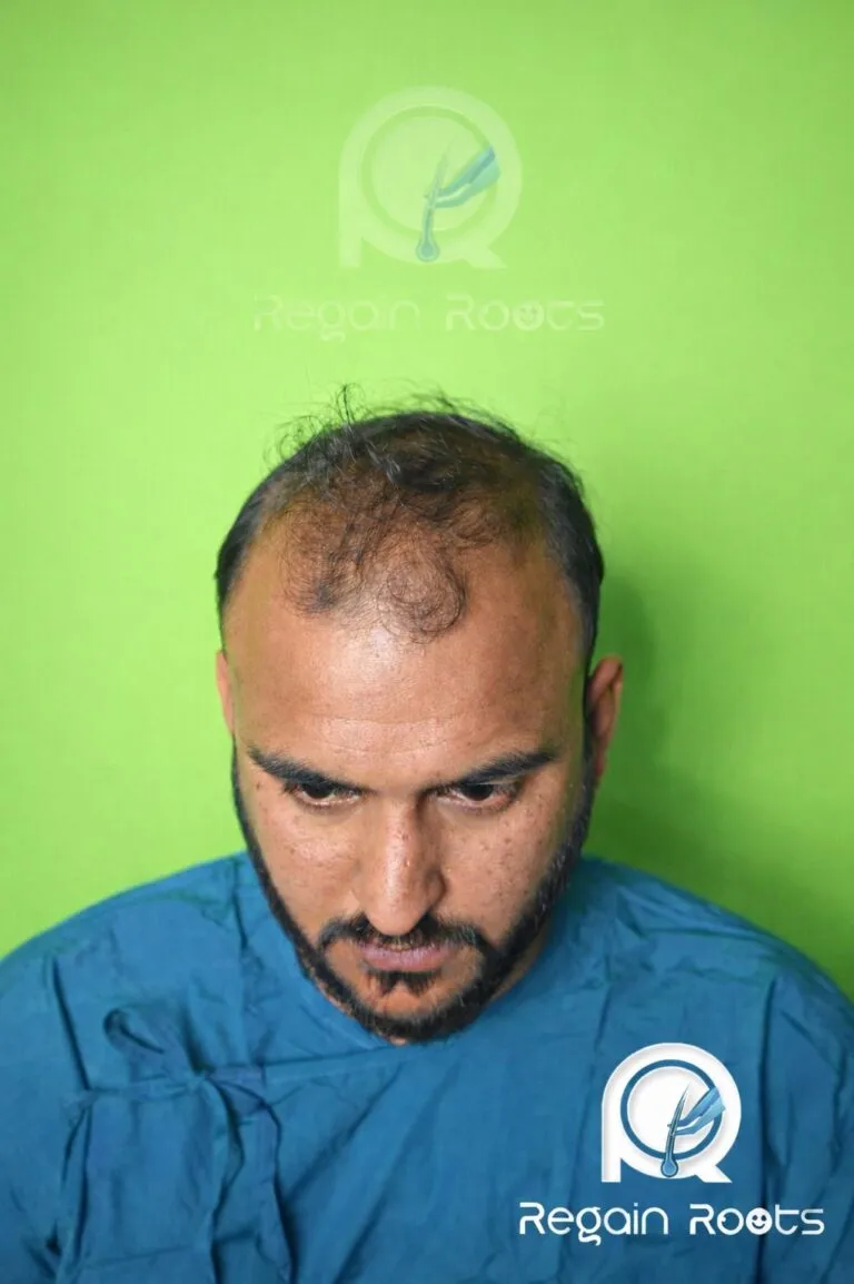hairlosimg