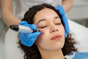 Micro Needling Treatment