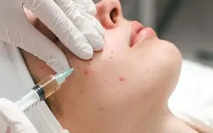 Acne Scars Treatment