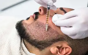 Beard Hair Transplant