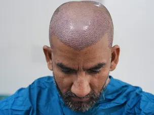 Hair Transplant